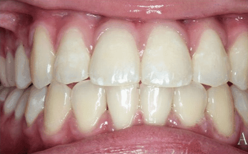 Orthodontic Alignment After