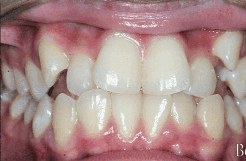 Orthodontic Alignment Before