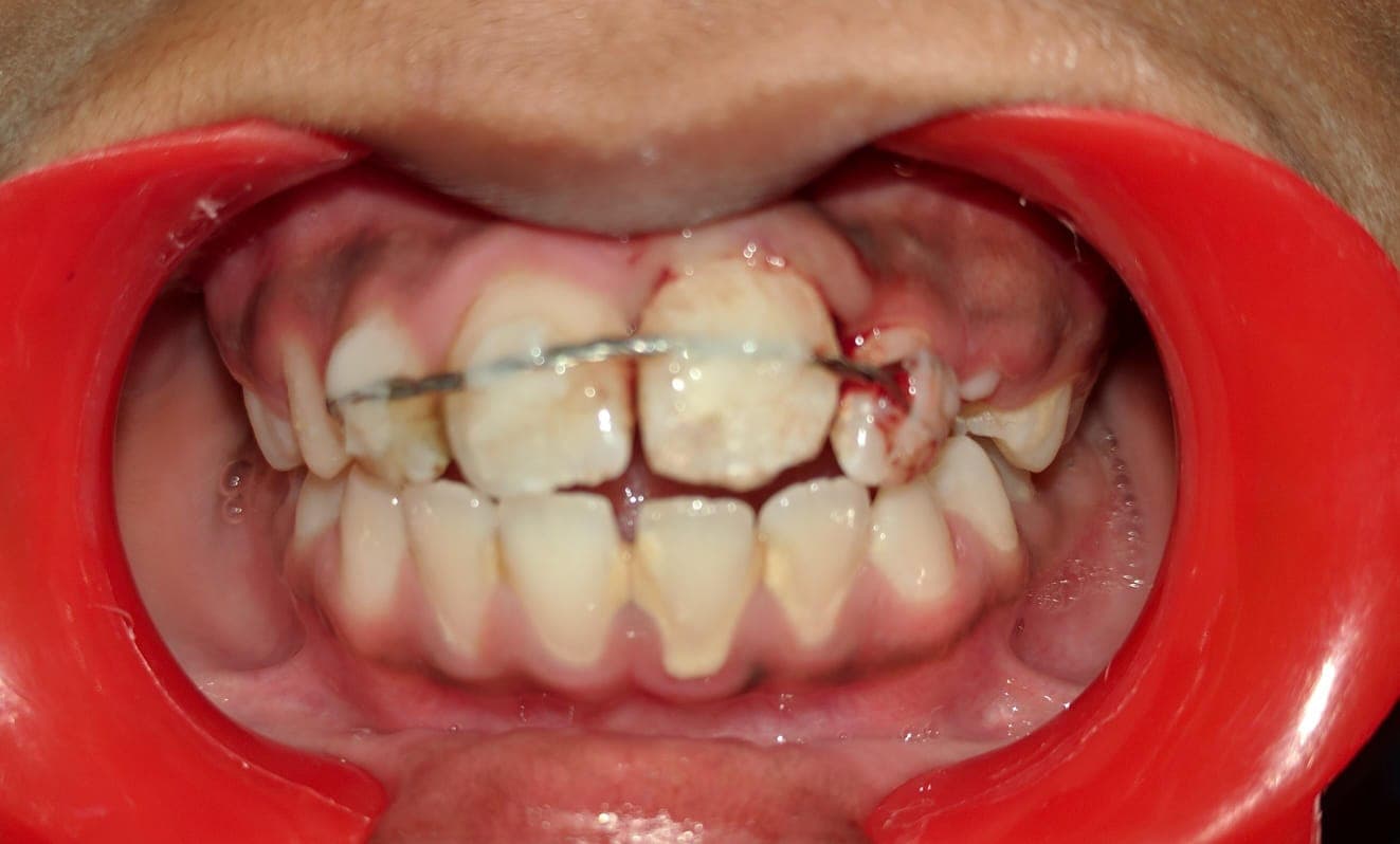 Teeth Fix After