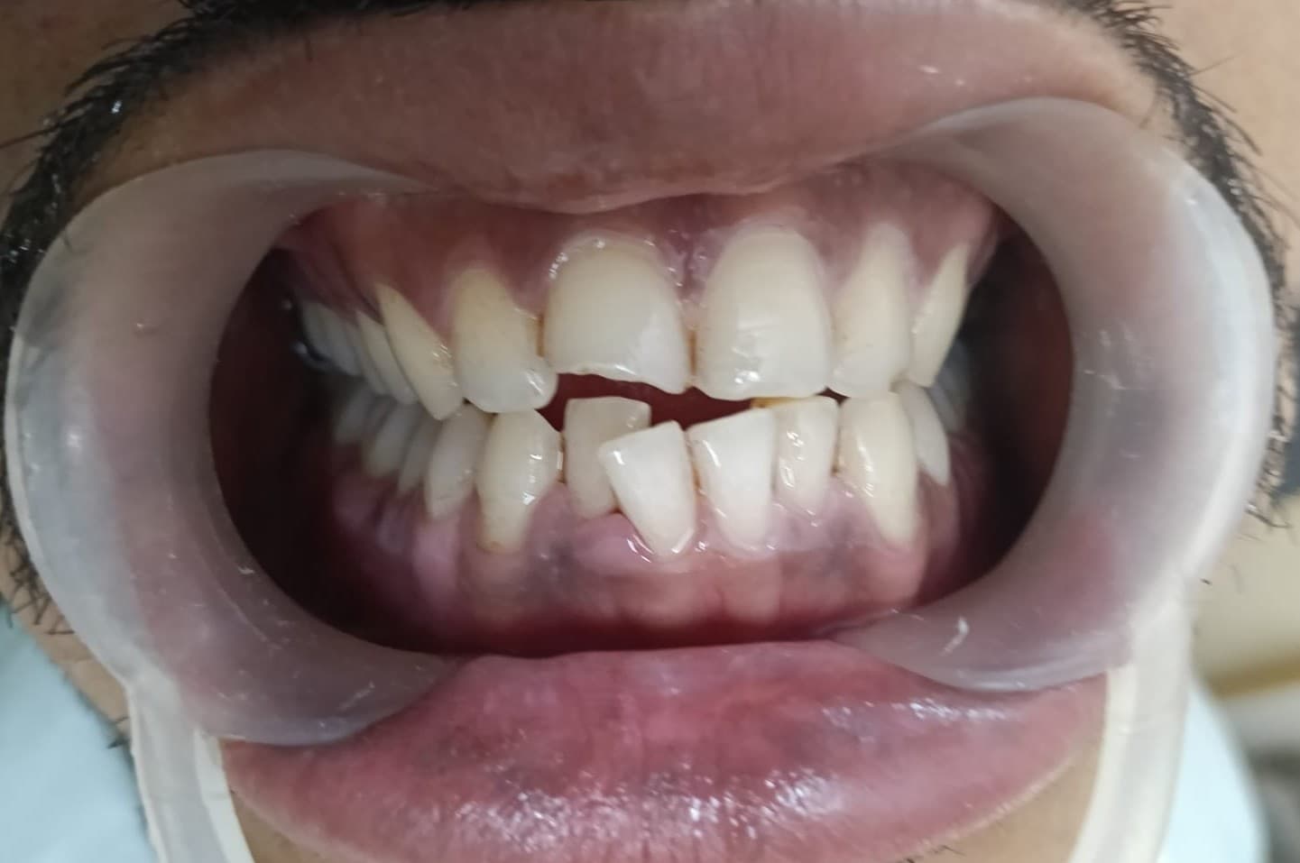 Teeth Whitening After