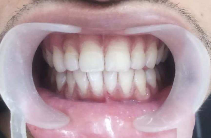 Teeth Whitening After