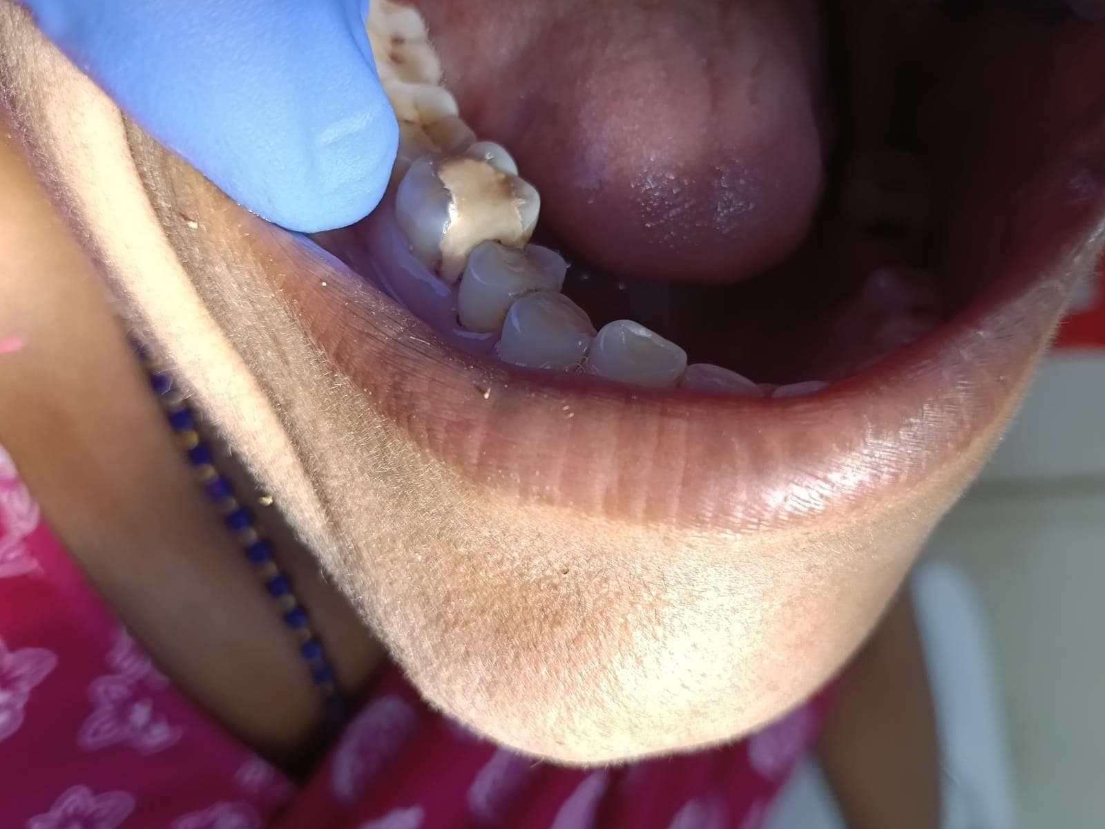 Cavity Fillings After
