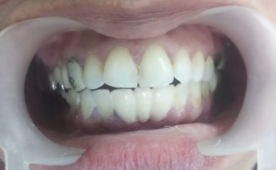 Tooth Supported Lower Anterior 3 Unit PFM Bridge After
