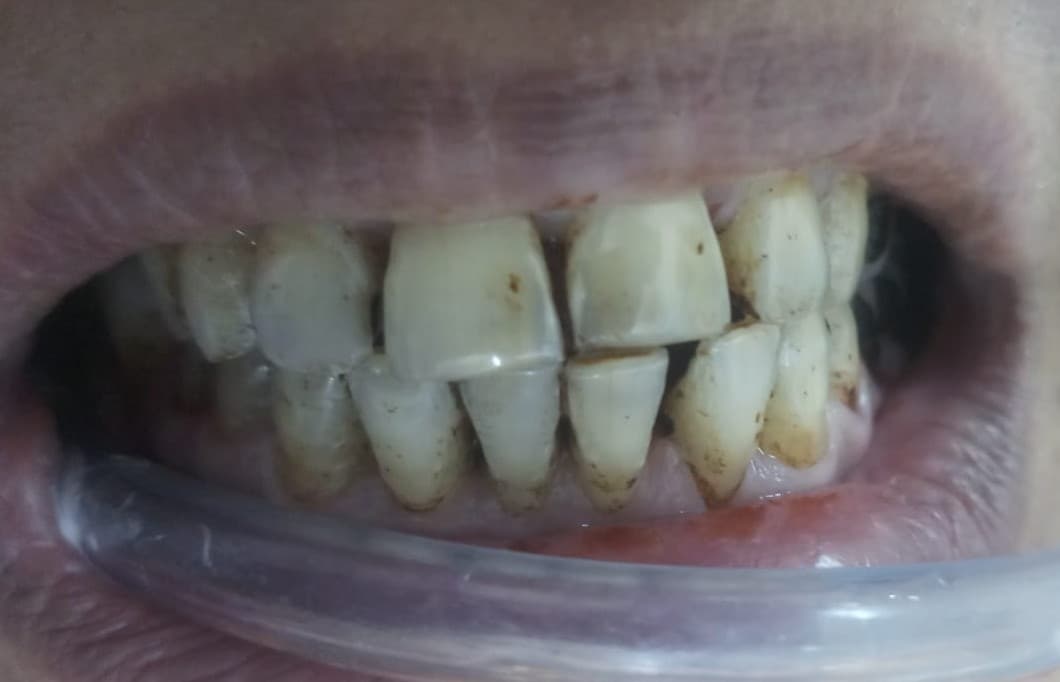 Teeth Whitening After