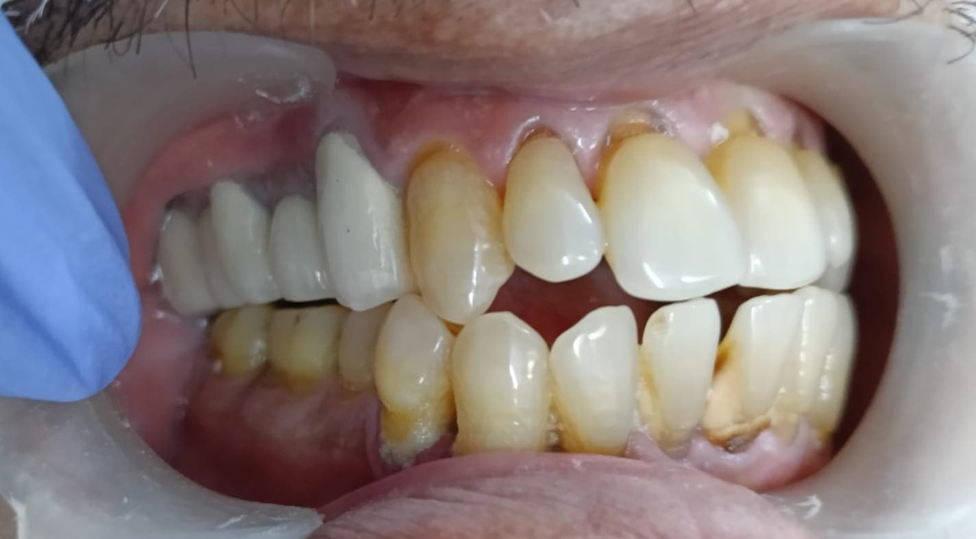 4 Unit Upper Posterior PFM Bridge After
