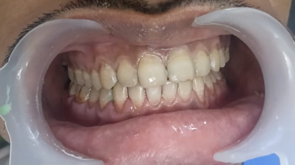 Teeth Whitening After