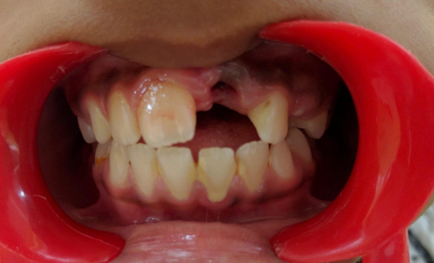 Teeth Fix Before