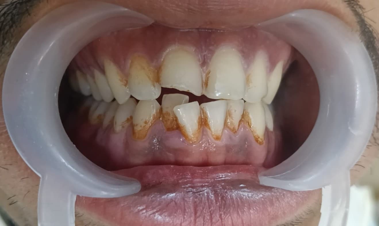 Teeth Whitening Before