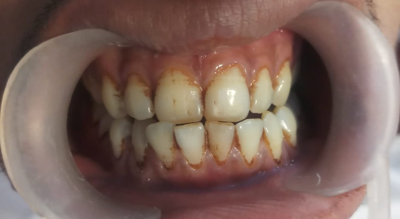 Teeth Whitening Before