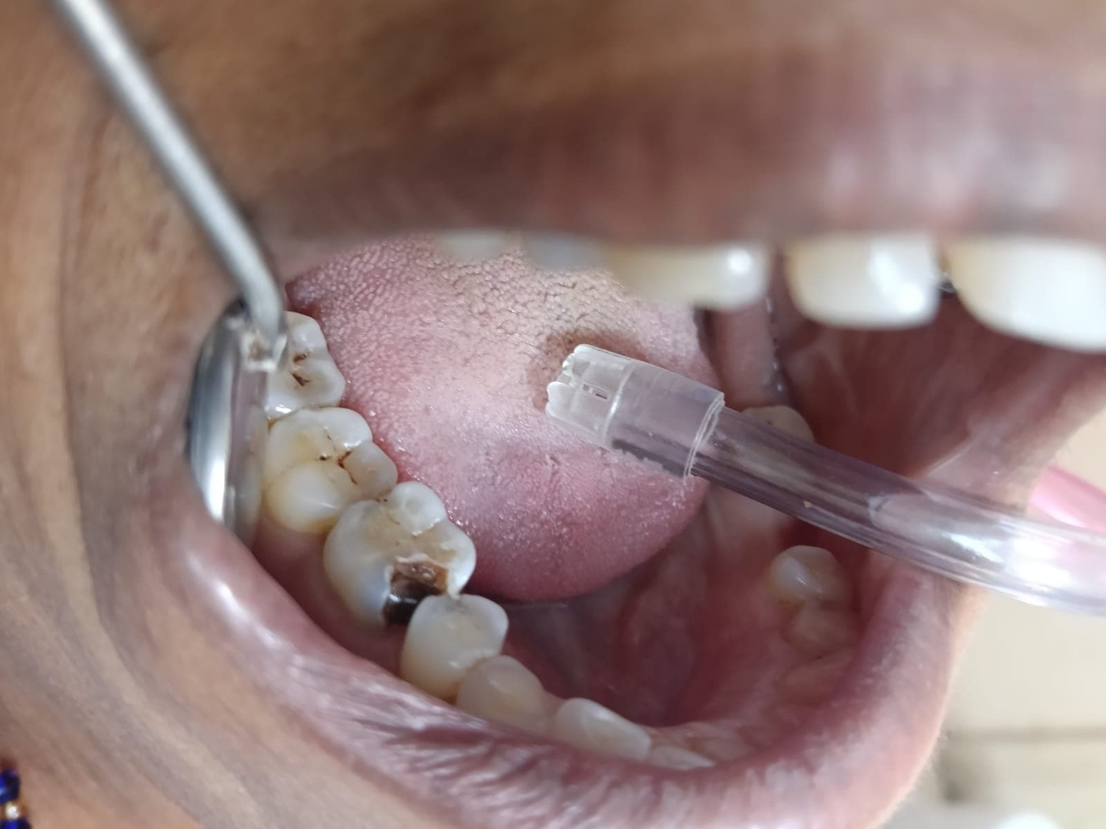 Cavity Fillings Before