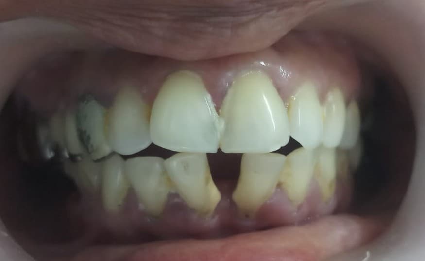 Tooth Supported Lower Anterior 3 Unit PFM Bridge Before
