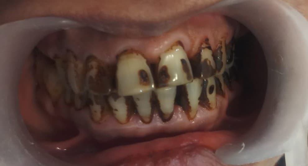 Teeth Whitening Before