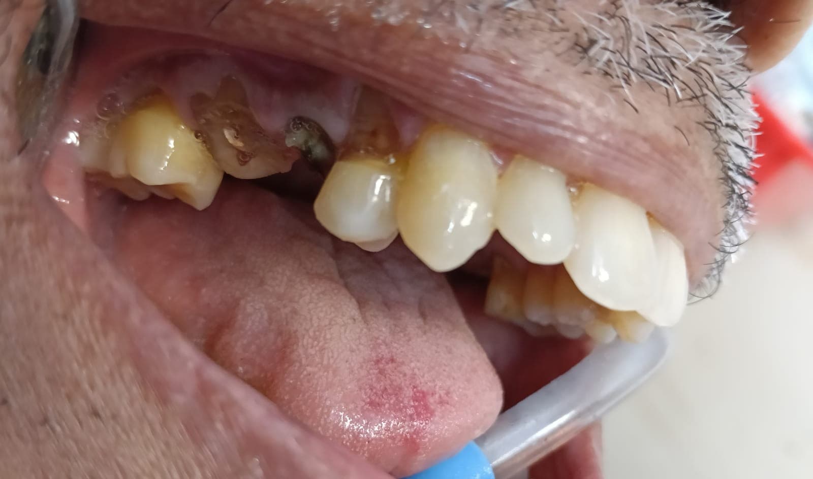 4 Unit Upper Posterior PFM Bridge Before