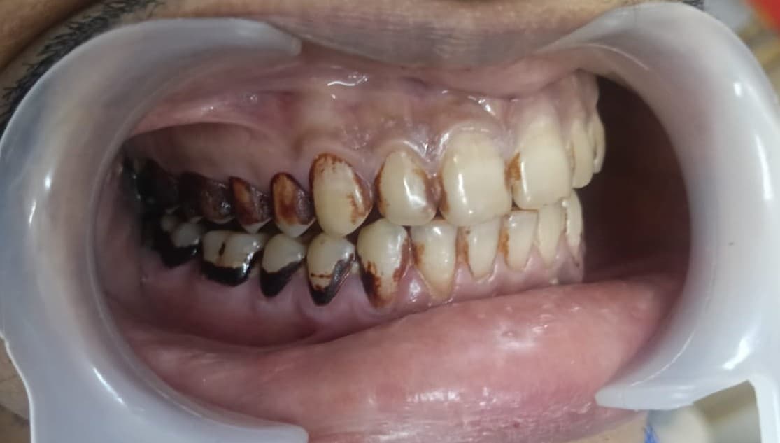 Teeth Whitening Before