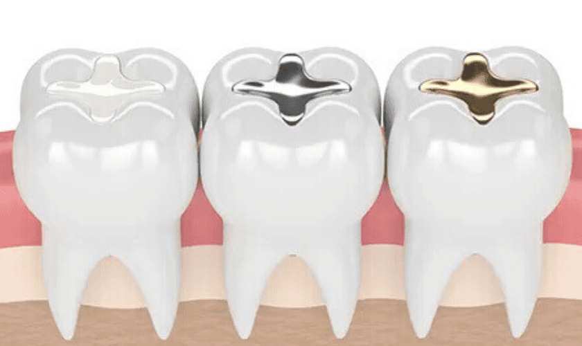 Composite Fillings