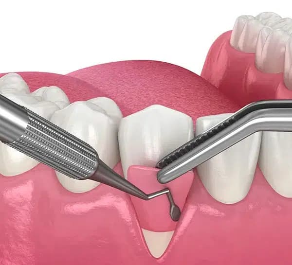 Gum Flap Surgery