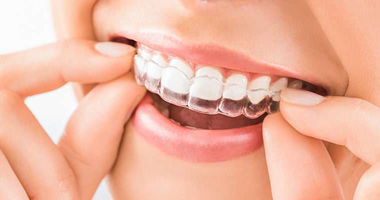 Bruxism Night Guards