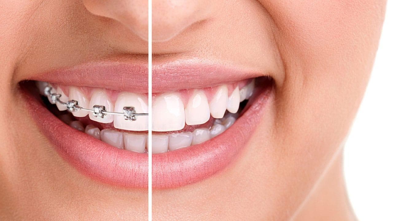 Orthodontic Braces