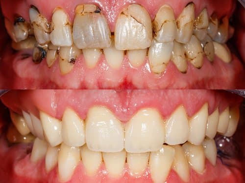 Full Mouth Rehab