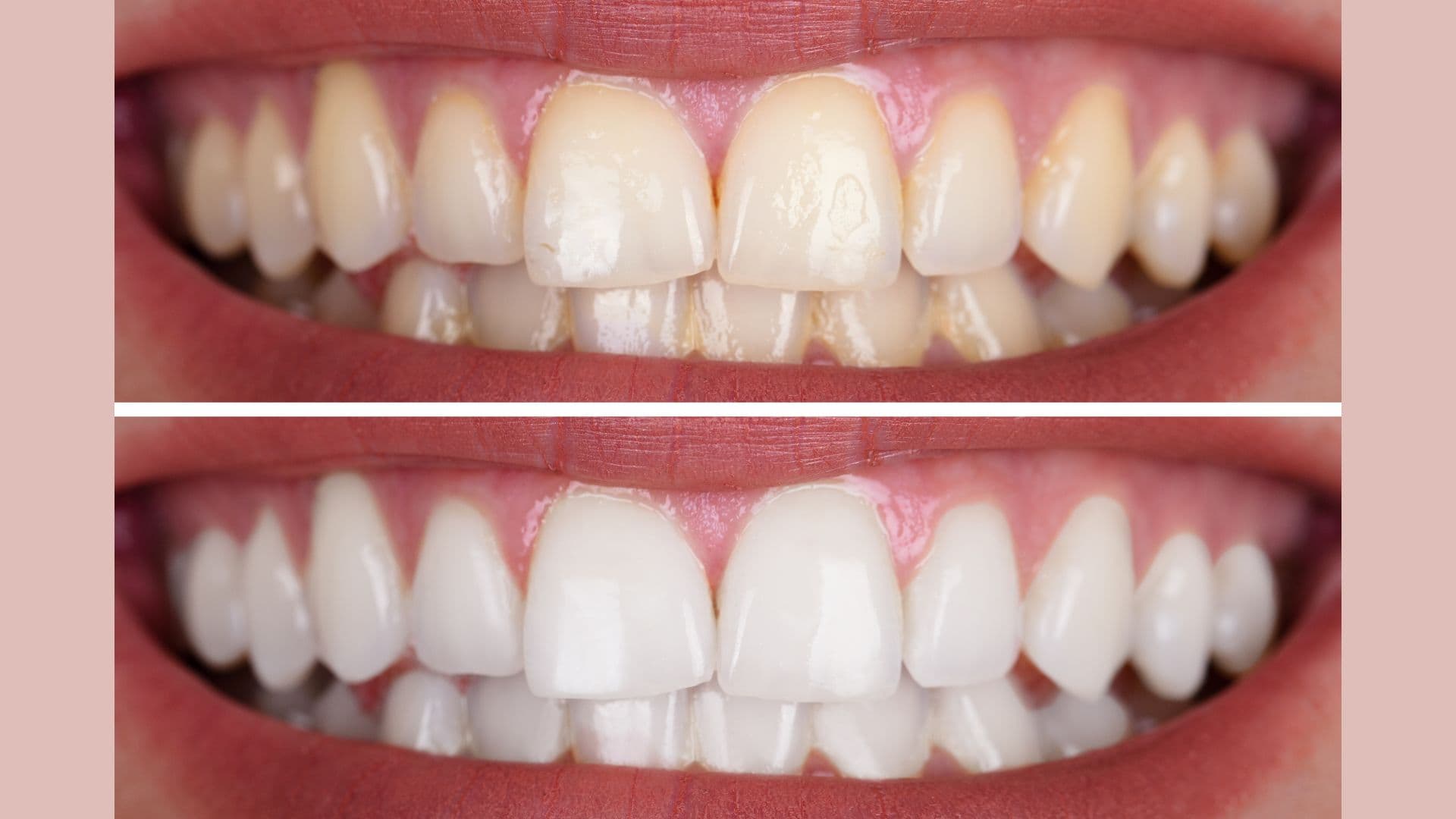 Professional Whitening