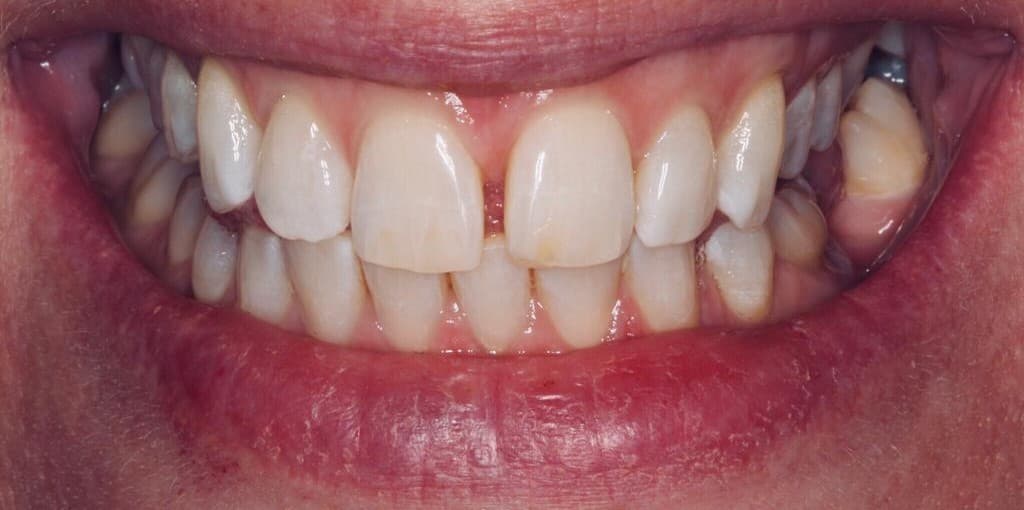 Teeth Whitening After