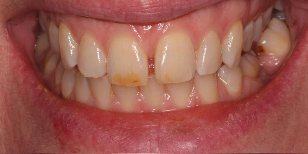 Teeth Whitening Before