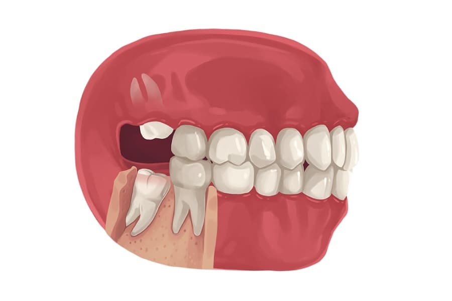 Wisdom Tooth Surgery